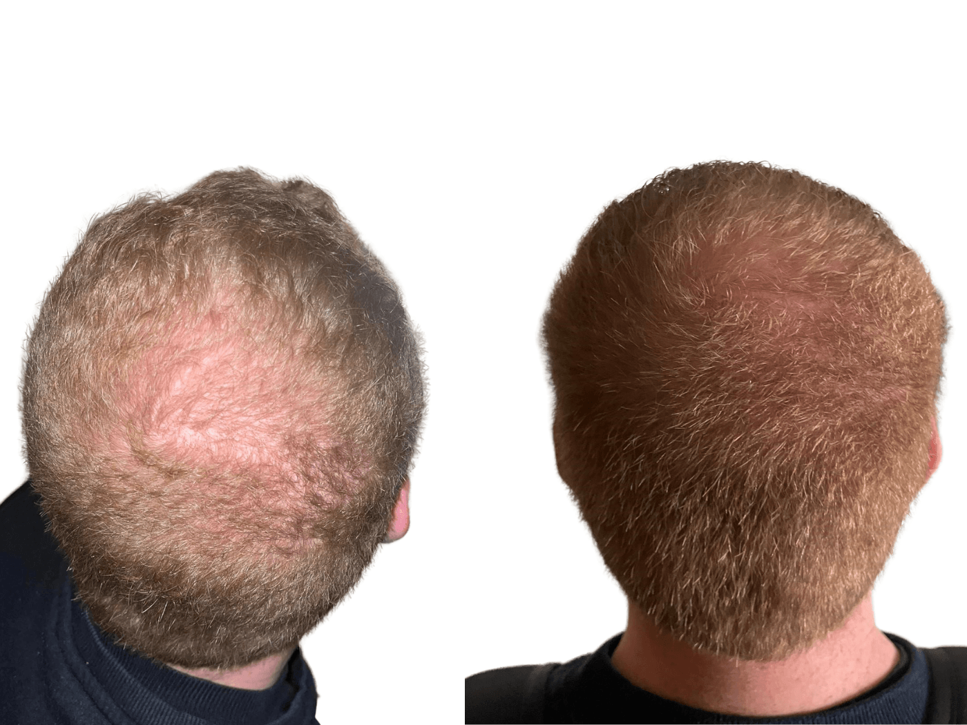 Vorher/Nachher-Bilder von einem Mann nach regelmässiger Anwendung des Hair Activating Serum von M2Beauté